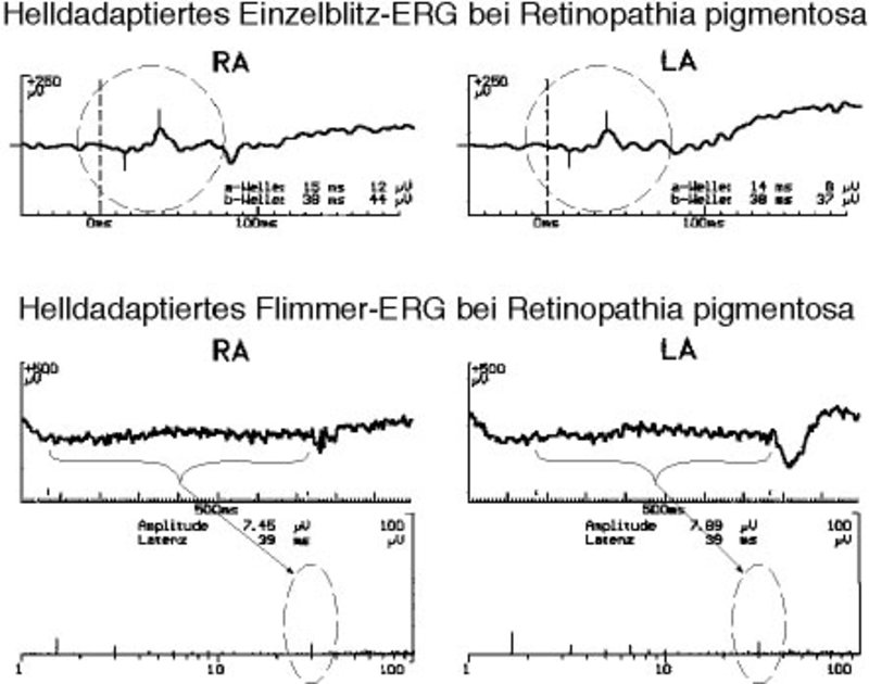 Photopisches Blitz-ERG bei Retinopathia pigmentosa. 