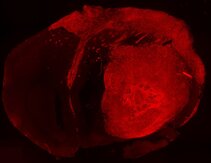 Brain tumor formation