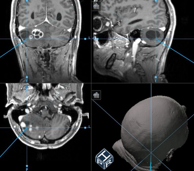 Intraoperative Neuronavigation: