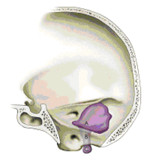 Tumors in the region of the caudal cranial nerves Tumors in the region of the caudal cranial nerves
