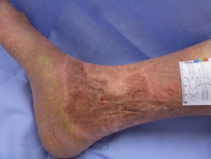 Mit Hauttransplantat gedecktes Bein