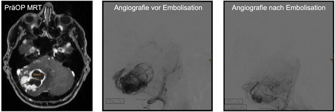 Präoperative Embolisation