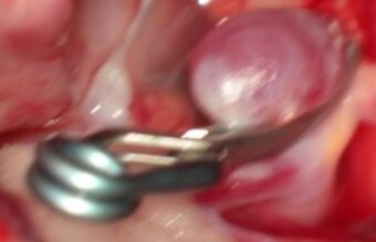 Microsurgical treatment by clipping Microsurgical treatment by clipping