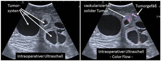 Intraoperativer Ultraschall