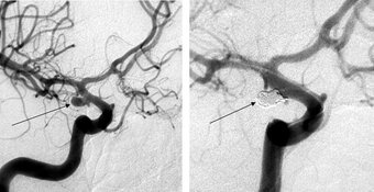 Coil embolisation Coil embolisation