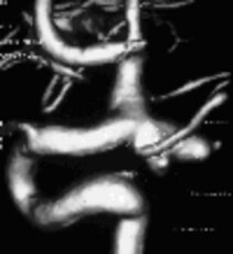 3D illustration of the same aneurysm 3D illustration of the same aneurysm