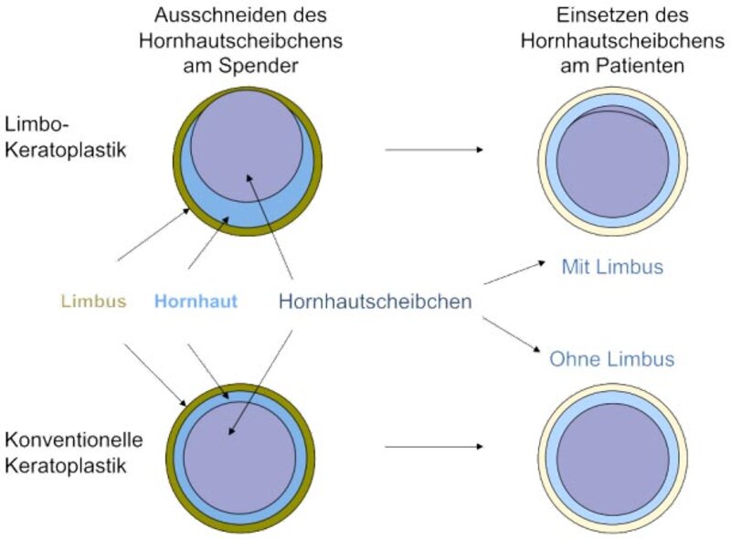 Prinzip der Limbokeratoplastik