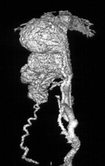 Angiographische Darstellung eines Angioms in 3D-Darstellung