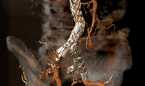 Ein Drahtgeflecht, das über die Leistenvene bis an den Ort der Schlagader vorgeschoben wird, kann einen lebensgefährlichen Riss der Bauchaorta verhindern. ©Universitätsklinikum Freiburg