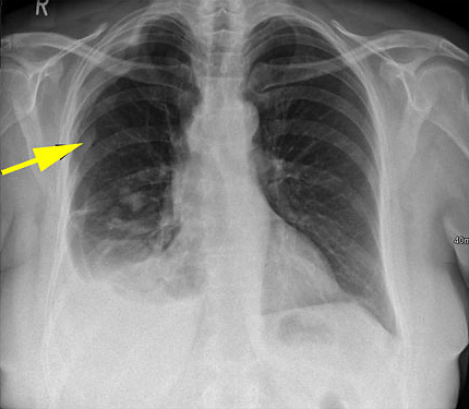 mesothelioma staging uptodate