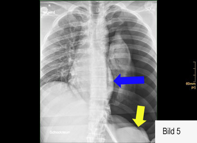 Röntgenbild flecken lunge weiße Streifenschatten